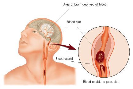 Blood Clots/Stroke - They Now Have a Fourth Indicator, the Tongue.